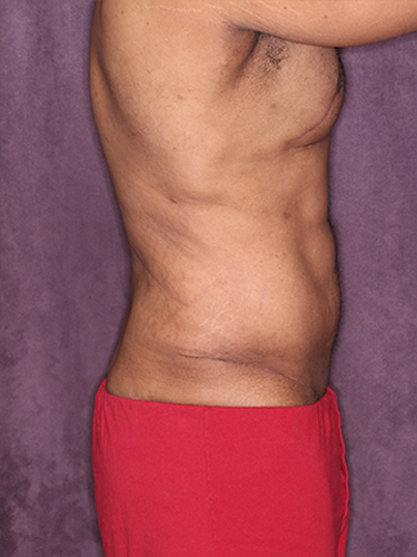 Case--33073 | After Gynecomastia 4