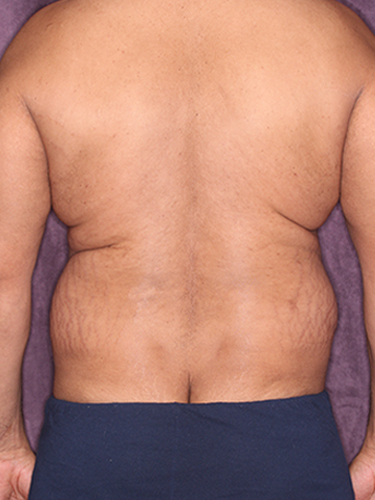 Case--33073 | Before Gynecomastia 6