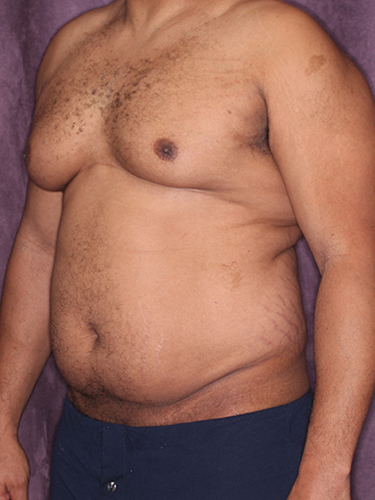 Case--33073 | Before Gynecomastia 3