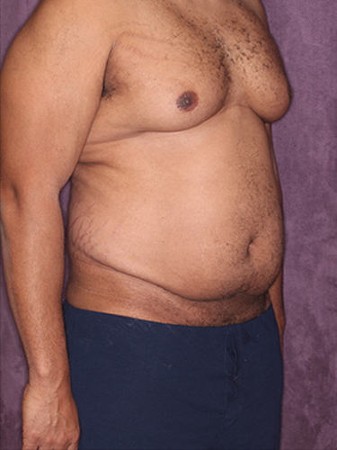Case--33073 | Before Gynecomastia 2