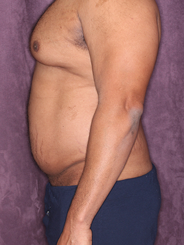 Case--33073 | Before Gynecomastia 5
