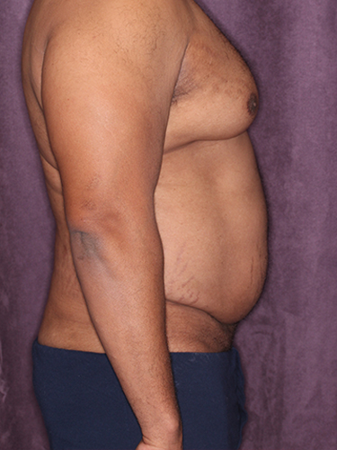Case--33073 | Before Gynecomastia 4