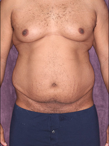 tummy tuck for men - Lemon8 Search