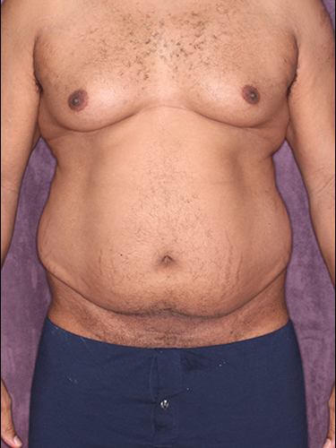 Case--33073 | Before Gynecomastia 1