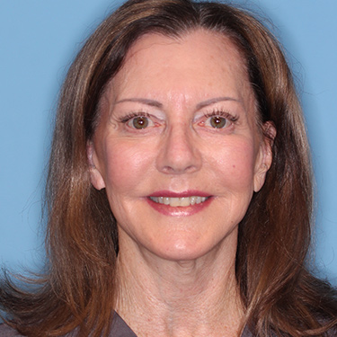 Case--36739 | After Brow Lift 1