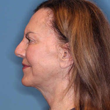 Case--36739 | After Brow Lift 5
