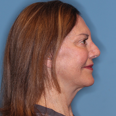 Case--36739 | After Brow Lift 4