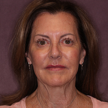 Case--36739 | Before Brow Lift 1