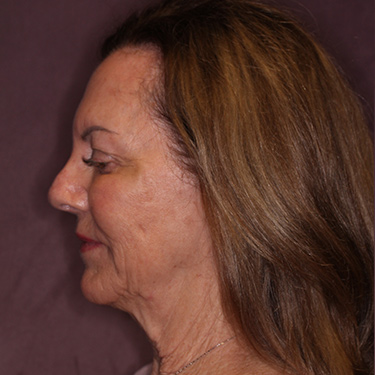 Case--36739 | Before Brow Lift 5