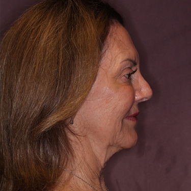 Case--36739 | Before Brow Lift 4