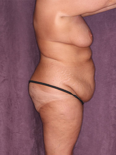 Case--34038 | Before Liposuction 4