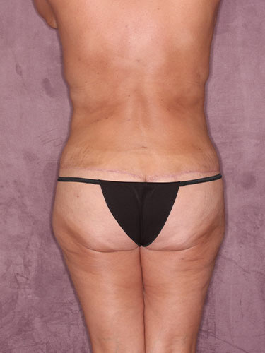 Case--34038 | After Liposuction 6