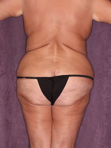 Case--34038 | Before Liposuction 6