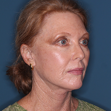 Case--36727 | After Facelift and Neck Lift 2