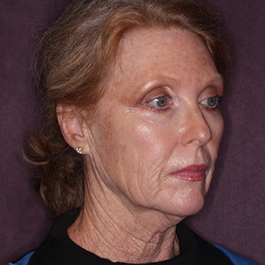 Case--36727 | Before Facelift and Neck Lift 2