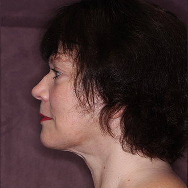 Case--35120 | After Eyelid Surgery (Blepharoplasty) 5