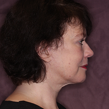 Case--35120 | After Eyelid Surgery (Blepharoplasty) 4