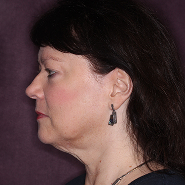 Case--35120 | Before Eyelid Surgery (Blepharoplasty) 5
