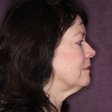 Case--35120 | Before Eyelid Surgery (Blepharoplasty) 4
