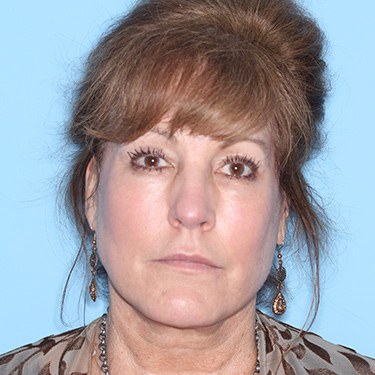 Case--36762 | After Eyelid Surgery (Blepharoplasty) 1