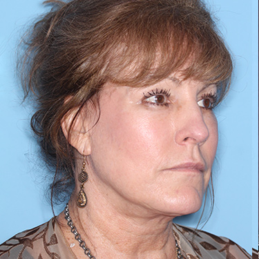 Case--36762 | After Eyelid Surgery (Blepharoplasty) 2