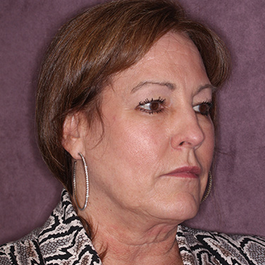 Case--36762 | Before Eyelid Surgery (Blepharoplasty) 2