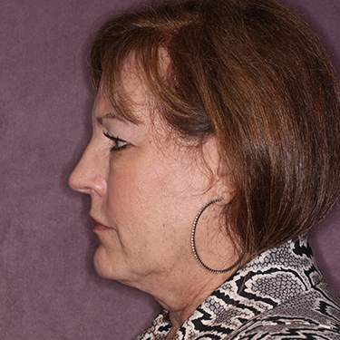 Case--36762 | Before Eyelid Surgery (Blepharoplasty) 5