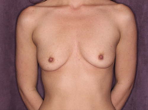 Case--35990 | Before Breast Augmentation 1