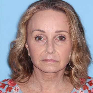 Case--36712 | After Brow Lift 1