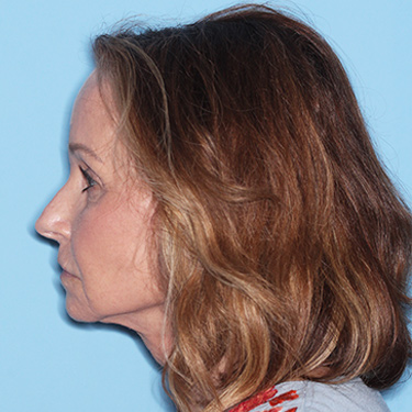 Case--36712 | After Brow Lift 5