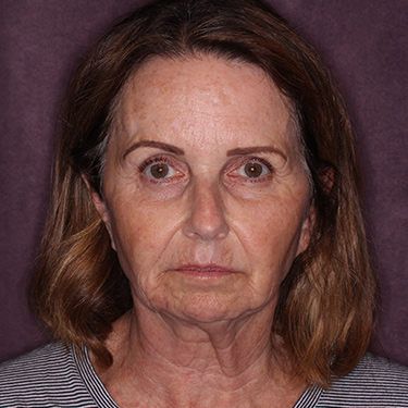 Case--36712 | Before Brow Lift 1
