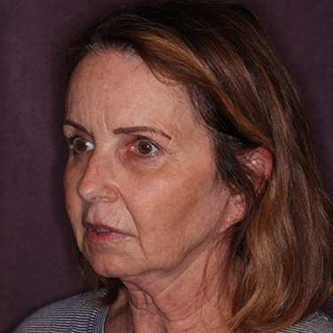 Case--36712 | Before Brow Lift 3
