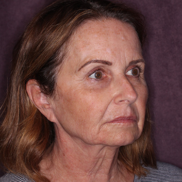 Case--36712 | Before Brow Lift 2
