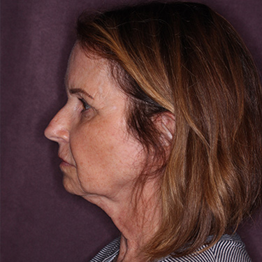 Case--36712 | Before Brow Lift 5
