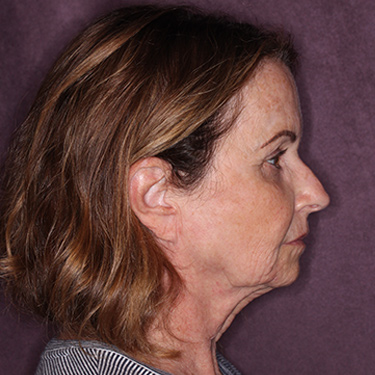 Case--36712 | Before Brow Lift 4