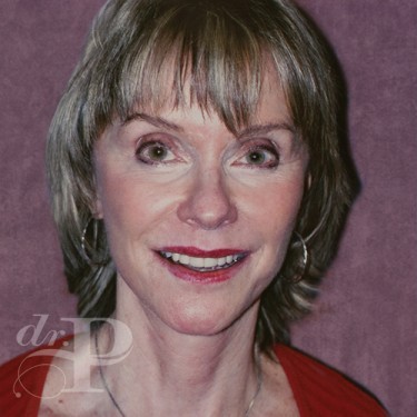 Case--29810 | After Facelift and Neck Lift 1