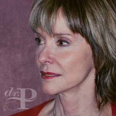 Case--29810 | After Facelift and Neck Lift 2