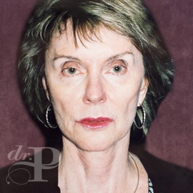 Case--29810 | Before Facelift and Neck Lift 1