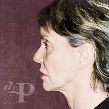 Case--29799 | Before Chemical Peel 4