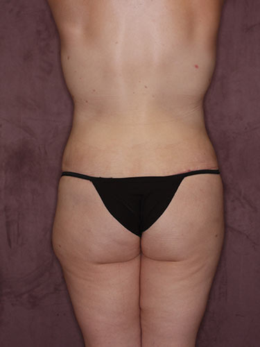 Case--34146 | After Fat Transfer to Buttocks 6