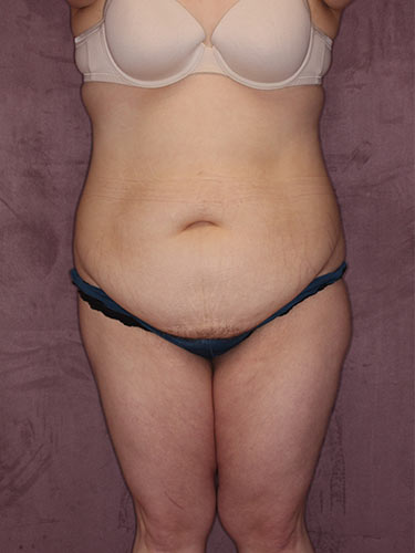 Case--34146 | Before Fat Transfer to Buttocks 1