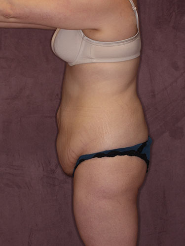Case--34146 | Before Fat Transfer to Buttocks 5