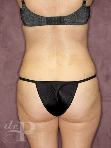 Case--480 | After True Form Tummy Tuck® 4