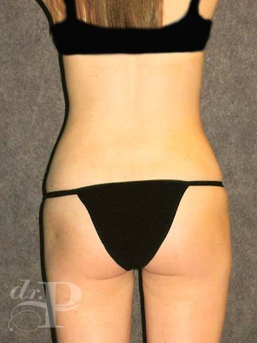 Case--1844 | After Liposuction 4