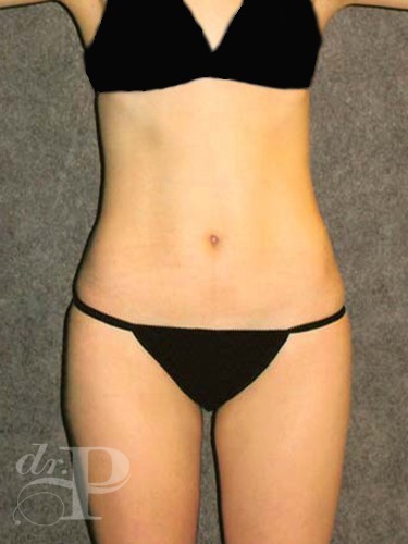 Case--1844 | After Liposuction 1