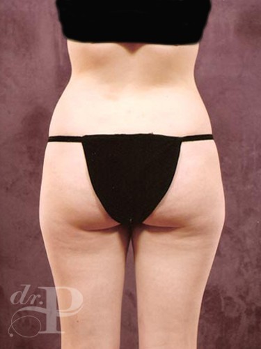 Case--1844 | Before Liposuction 4