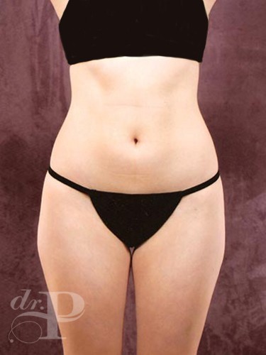 Case--1844 | Before Liposuction 1