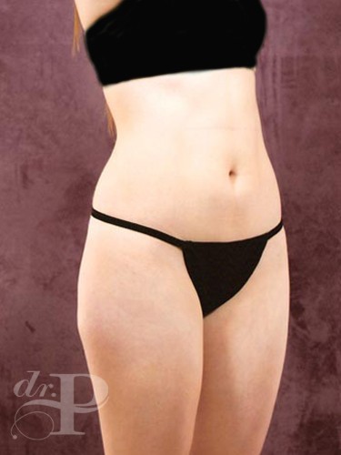 Case--1844 | Before Liposuction 2
