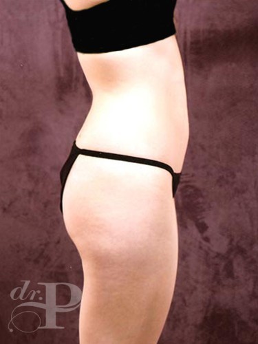 Case--1844 | Before Liposuction 3