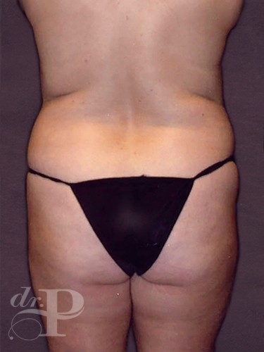 Case--29269 | Before True Form Tummy Tuck® with Lower Body Lift (Buttock Lift) 4
